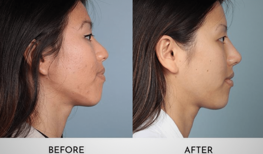 DCF Rhinoplasty: Understanding the Procedure