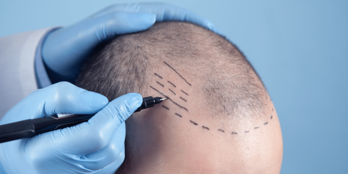 The Transformative Power of Hair Transplantation
